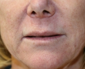 Feel Beautiful - Smile Lines (Nasal-Labial Folds) Filler - Before Photo